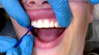 Tips For Applying Fluoride Varnish [upl. by Yahsat]