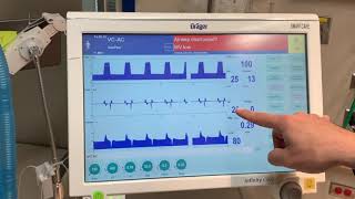 Introduction to a Drager Ventilator [upl. by Ahsaek]