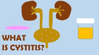 What is Cystitis [upl. by Nwahsirhc]