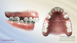 Upper 2nd Bicuspid Extraction  Overjet  Orthodontic Treatment [upl. by Etnoval400]