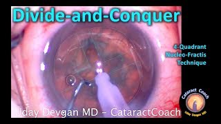 Divide and Conquer Phaco Technique for Cataract Surgery [upl. by Myrvyn]