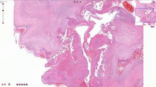 Infective Endocarditis  Histopathology [upl. by Ymmot]