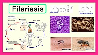 filariasis [upl. by Notserp799]