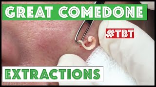 Greatest Blackheads and Whiteheads TBT [upl. by Zipporah]