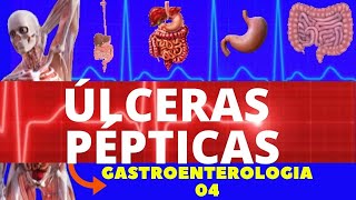 ÚLCERAS PÉPTICAS CAUSAS SINTOMAS DIAGNÓSTICO E TRATAMENTO  GASTROENTEROLOGIA [upl. by Amaleta]