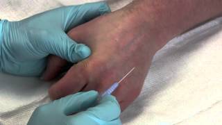 Intravenous Catheter Placement [upl. by Conah]