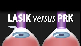 LASIK or PRK Which is right for me Animation [upl. by Lede]