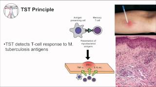 Tuberculosis Diagnosis [upl. by Bradski102]