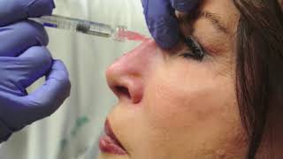 Nonsurgical Rhinoplasty [upl. by Ailecara]