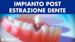 Impianto dentale immediato postestrazione dente © [upl. by Willetta]