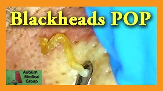 Blackheads POP  Auburn Medical Group [upl. by Nortal]