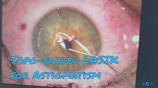 Contoura Vision Laser Eye Surgery for Astigmatism  Topographyguided LASIK PRK [upl. by Ardena]