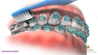 Life with Braces  Brushing amp Flossing [upl. by Apfel]