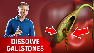 Do This to Help Dissolve Gallstones [upl. by Beall]