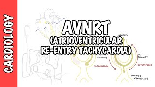 AVRNT atrioventricular reentry tachycardia  causes pathophysiology treatment [upl. by Latrena]