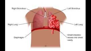 Diaphragmatic Hernia [upl. by Ettenotna]