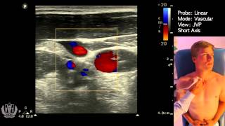 JVP Jugular Venous Pulsation Evaluation using Ultrasound [upl. by Taddeusz]