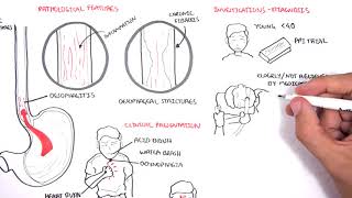 GORD GERD Gastro Oesophageal Reflux Disease  Overview pathophysiology treatment [upl. by Nee]