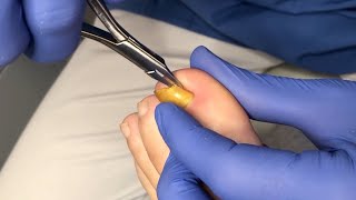 Usuwanie wrastającego fragmentu paznokcia  Ingrown toenail removal [upl. by Anrehs]