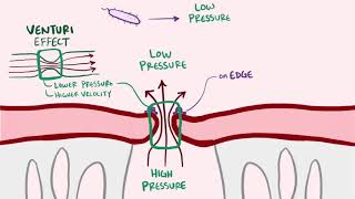 Endocarditis infective libman sacks causes symptoms treatment amp pathology [upl. by Torbart]