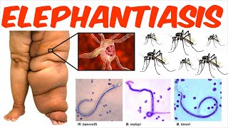 Lymphatic Filariasis  Elephantiasis [upl. by Oby]