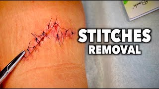 REMOVING 13 STITCHES From a Huge Leg Wound  Dr Paul [upl. by Gaivn701]