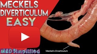 Meckels Diverticulum Made Easy [upl. by Glad]