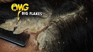 Dandruff Removal Big Flakes Satisfying 811 [upl. by Rech]