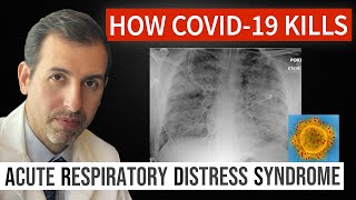 How Coronavirus Kills Acute Respiratory Distress Syndrome ARDS amp COVID 19 Treatment [upl. by Lasala]