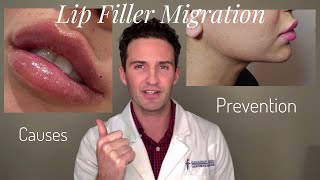 Lip Filler Migration Causes amp Prevention [upl. by Orren462]