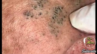 Dr Pop  Deep Blackheads in old Skin removing amp treatment 2020 Part 4 HD [upl. by Ecyob]