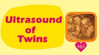 Sonography of Twins [upl. by Asquith]