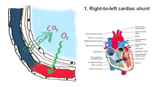 Respiratory Failure [upl. by Rosalinda]