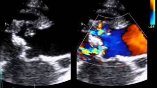 Infective Endocarditis  Aortic Root Abcess [upl. by Nivat]