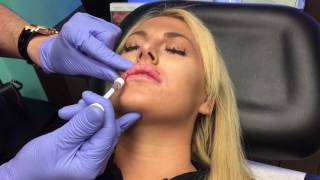 Microdroplet lip injection Using Restylane Juvederm [upl. by Anilat560]