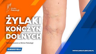 Żylaki kończyn dolnych  metody leczenia [upl. by Aniram]