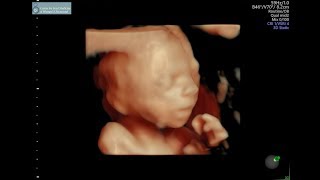 20 week ultrasound [upl. by Salohcim149]