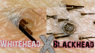 Blackhead and Whitehead on the ScalpSatisfying ExtractionClose Up [upl. by Irolam932]