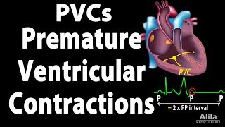 Premature Ventricular Contractions PVCs Animation [upl. by Akirdnwahs]