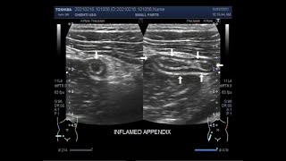 Abruptio Placentae vs Placenta Previa Nursing NCLEX Symptoms Causes Management Placental Abruption [upl. by Eybbob]