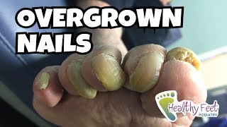 Overgrown Toe Nails [upl. by Constantina]