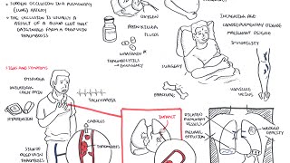 Pulmonary Embolism  Overview [upl. by Fellows]