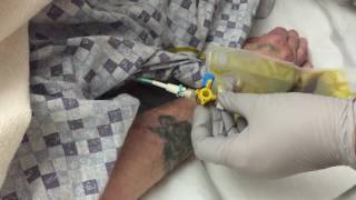 BASIC SET UP LAP CHOLECYSTECTOMY [upl. by Aibsel]