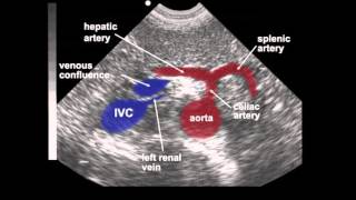 Abdominal Aortic Aneurysm AAA Ultrasound [upl. by Kenway]