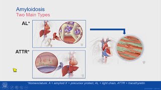 Multiple Myeloma  signs and symptoms pathophysiology treatment [upl. by Itnahsa]